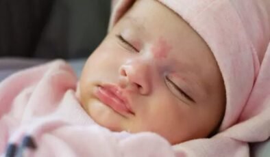 Doğum lekeleri neden oluşur?