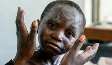 Cezaevinde Mpox ölümü! Yeni varyant ortaya çıktı: Hızla yayılıyor