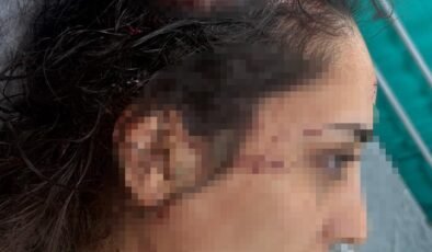 Adana’da bir bayan daha sokak köpeklerinin gayesi oldu