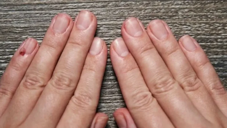 Ayak tırnağınızdaki o detaya dikkat: Sessizce yayılan kanserin habercisi olabilir!
