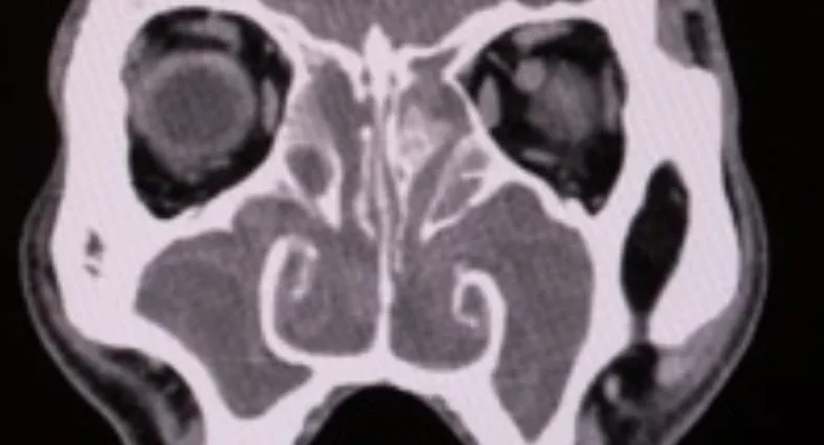 Geçmeyen Burun Tıkanıklığı: Basit Bir Grip mi, Yoksa Kronik Sinüzit mi?