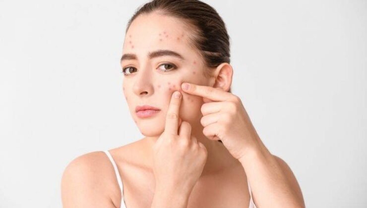 Pürüzsüz cilde kavuşmanızı sağlayan bakım rehberi: Sivilceden en hızlı kurtulmanın 7 yolu