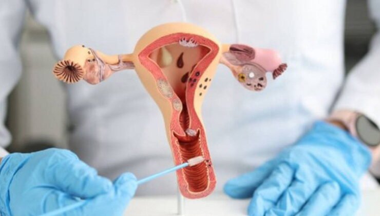 Çikolata kisti sadece kadın hastalığı değil: Böbrek yetmezliği ve nefes darlığına yol açıyor!