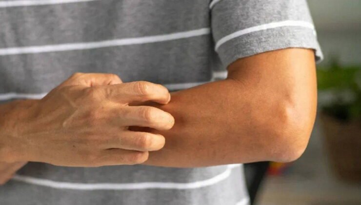 Vücuttaki o kaşıntıyı hafife almayın: Onkologlar uyardı, 4 farklı kanserin habercisi olabilir